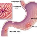 Petua Hilangkan Gastrik Petua Hilangkan Gastrik