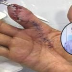 Doktor Ini Dedahkan Bahaya Kuman Pemakan Daging Yang Ramai Orang Tak Tahu. Doktor Ini Dedahkan Bahaya Kuman Pemakan Daging Yang Ramai Orang Tak Tahu.