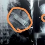 Doktor Temui Sesuatu Yang Tak Dijangka Di Dalam Perut Pesakit. Doktor Temui Sesuatu Yang Tak Dijangka Di Dalam Perut Pesakit.