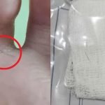 Doktor Keluarkan Rambut Yg Bergerak-Gerak Dalam Kaki Kanak-Kanak. Doktor Keluarkan Rambut Yg Bergerak-Gerak Dalam Kaki Kanak-Kanak.