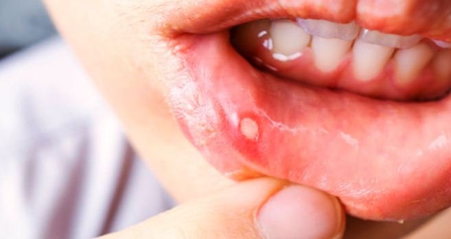 13 Petua Hilangkan Ulser Mulut. Boleh Cuba!