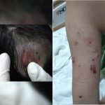 Kanak-Kanak Cedera Diserang Anjing Liar Kanak-Kanak Cedera Diserang Anjing Liar