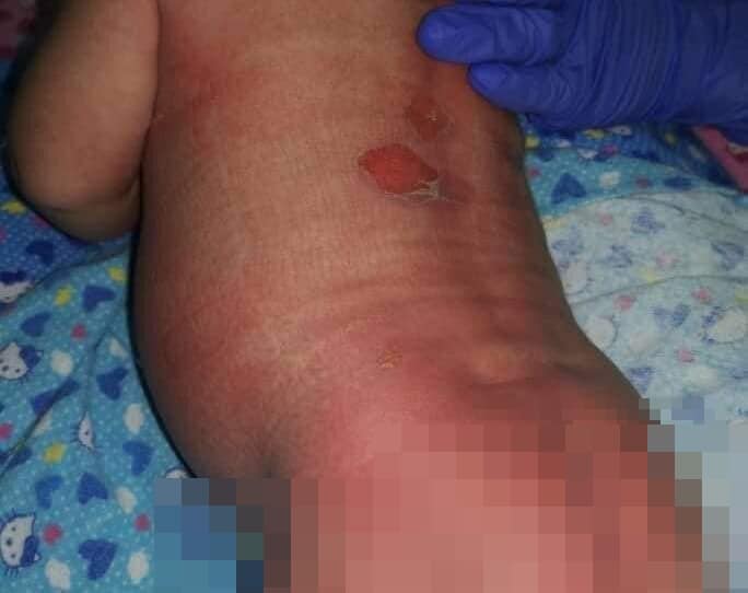 Bayi Melecur Akibat Dimandikan Dengan Air Panas, Pusat Penjagaan Bayi Dan Ibu Berpantang Minta 'Settle Tepi'