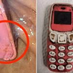 Lelaki Telan Telefon Nokia 3310, Ini Yang Berlaku Selepas Empat Hari