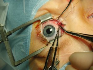 CEMAS! Seorang Lelaki Buta Seumur Hidup Akibat Kecuaian Doktor.