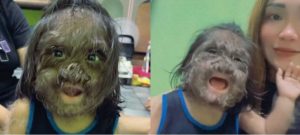 Budak Hidap 'Sindrom Werewolf' Sejak Lahir. Netizen Luah Kata-Kata Semangat!