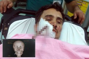 Sebatang Bar Keluli Tertusuk Pada Muka Pekerja Pembinaan