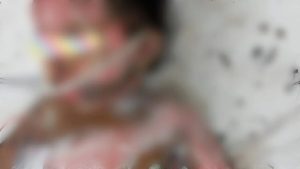 Kanak-Kanak 4 Tahun Melecur Hampir Separuh Badan Semasa Main Bunga Api